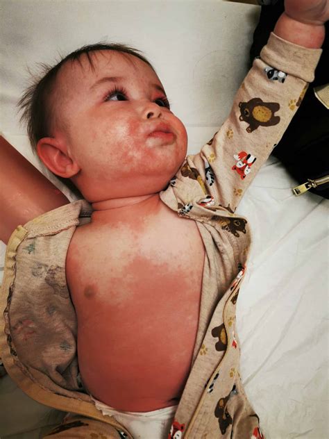 Symptoms of Allergic Reactions in Babies - Solid Starts