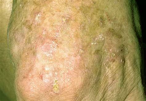 Actinic keratosis or solar keratosis is a problem in which you can observe bumps or rough patches on the skin. Actinic Keratosis Pictures