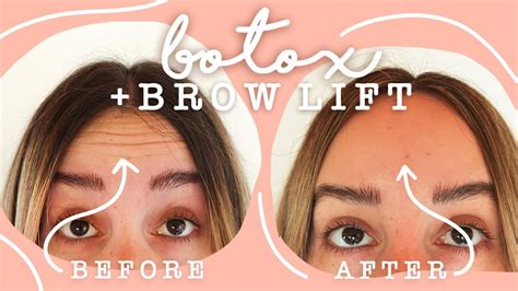 Getting Botox Brow Lift Before And After Vlog Youtube
