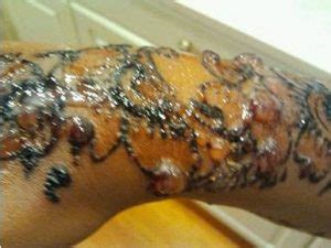 Temporary black henna tattoos may increase your risk of allergy. Dangers of Using Black Henna | EthnoMed