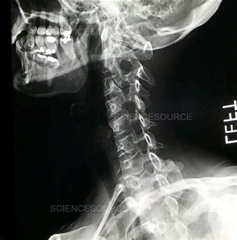 Normal Cervical Spine X Ray Stock Image Science Source Images