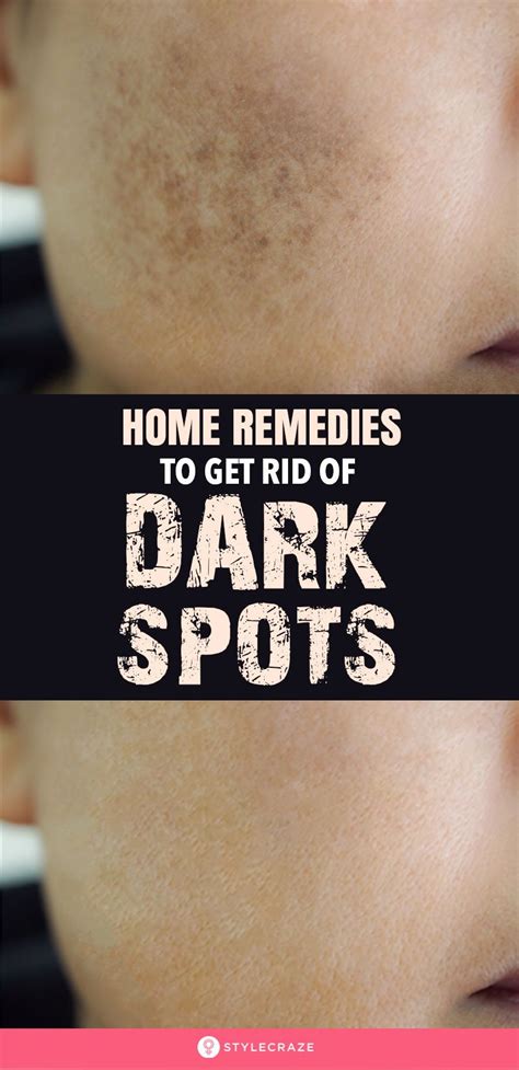 How To Remove Dark Spots On Face Fast 6 Home Remedies Dark Spots On