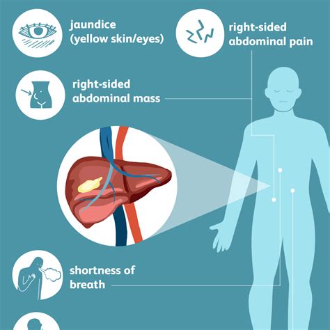 There are some symptoms of liver cancer which are also commonly seen in other conditions as well and therefore are hard to be associated with something as. Liver Cancer: Signs, Symptoms, and Complications