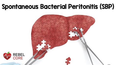 Spontaneous Bacterial Peritonitis Sbp Rebel Em Emergency Medicine