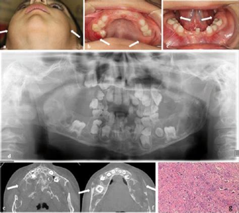 Clinical View Of The Proband Patient Iv1 With Cherubism Showing