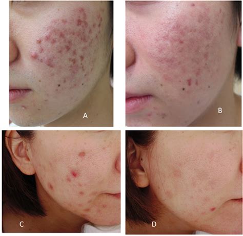 Effect Of A Cosmetic Use With 2 Isostearyl L Ascorbic Acid Gel For