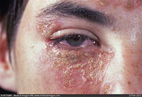 Stock Image Close Up Of Impetigo Contagiosa Affecting The Eye Area