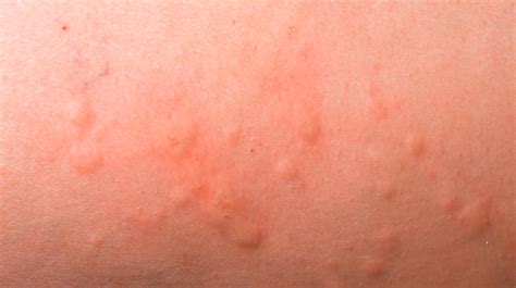 Everything You Need To Know About An Amoxicillin Rash Umedoc