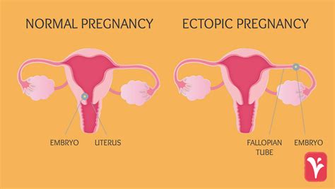 Ectopic Pregnancies What You Need To Know Austin Women S Health Center