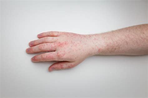 Patient Shows Arm And Hand With Red Itchy Painful Rash Allergic