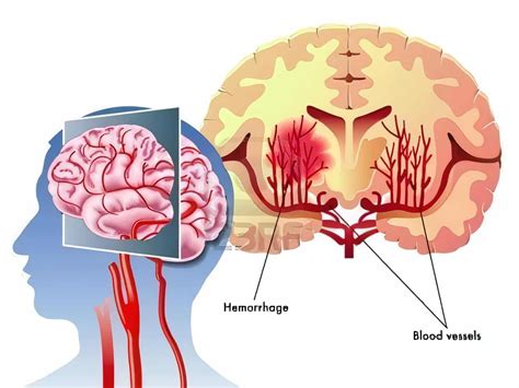 Directrices Para La Hemorragia Cerebral Noticias De Medicina
