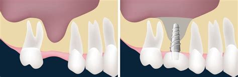 Sinus Lift Fairfax Va Fairfax Dental Dental Implant Surgery