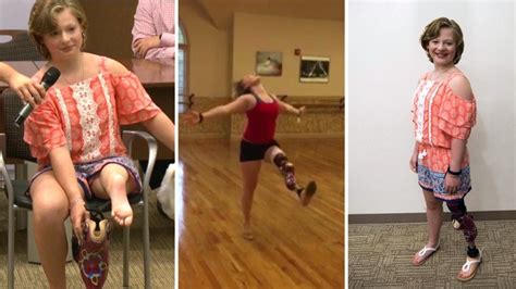 Rare Surgery Allows 12 Year Old To Keep Dancing After Losing Leg To