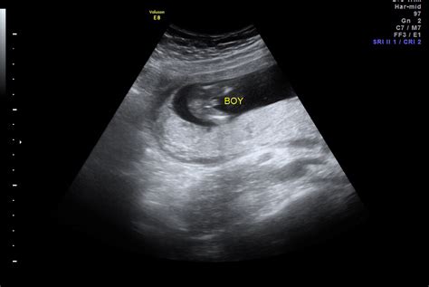 Can Ultrasounds Be Wrong In Early Pregnancy Pregnancywalls