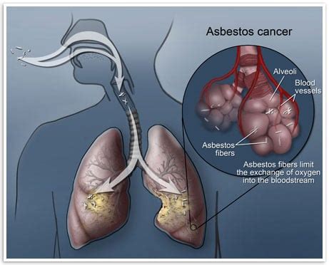 Asbestos Poisoning Blogs Gaylord Nantais