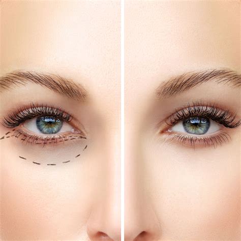 Upper And Under Eyelid Surgery Dubai Double Eyelid Eyebag Surgery Dubai