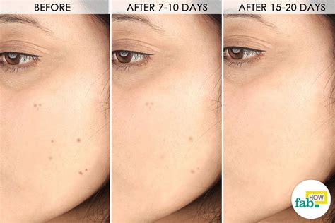 How To Get Rid Of Dark Spots On Face With Just 1 Ingredient