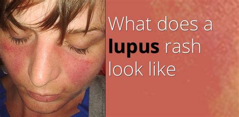 One Of The Most Common Signs Of The Condition Known As Lupus Is Also