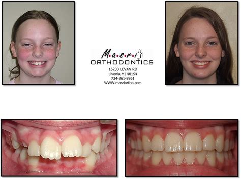 Open Bite Jaw Surgery And Braces Before And After Treatment