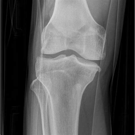 Lateral Radiograph Of Knee Showing Dislocated Patella Figure 2 Ap