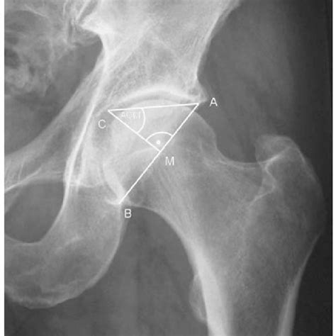The Depth Of The Acetabulum Was Determined By The Acm Angle Download