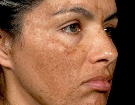 Melasma Lowe Dermatology Laser Procedure Correction