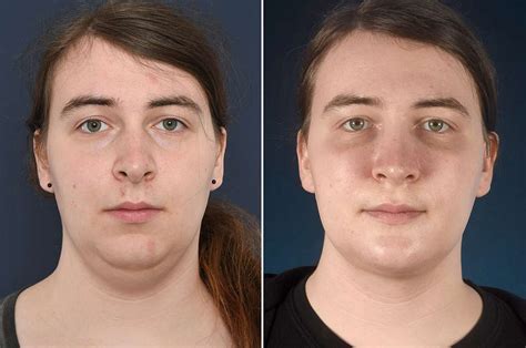 Facial Feminization Surgery Chin Surgery Feminizing The Chin