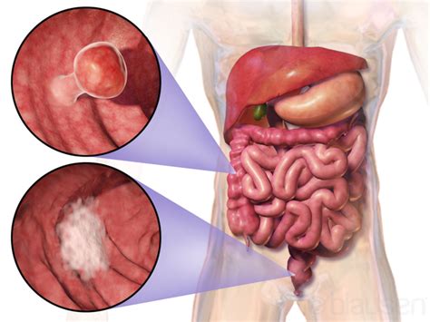 Colon Cancer Colorectal Cancer — Causes Symptoms And Prognosis