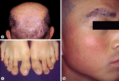 Figure 1 From Folliculitis Decalvans Associated With Micronychia
