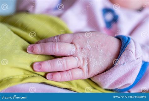 Newborns Skin Peeling Stock Photo Image Of Child Vernix 95273172