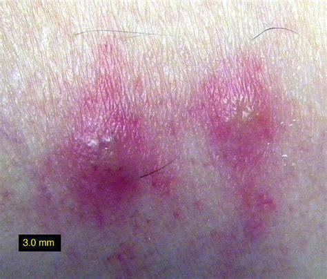 Chiggers Mite Bites Rash Pictures Treatment Eradication