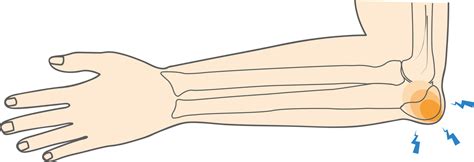 What Is Olecranon Bursitis And How To Manage Elbow Pain Upswing Health