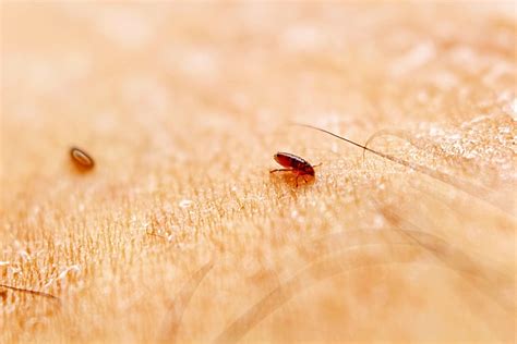What Diseases Can Be Caused By Lice Infestation Licedoctors