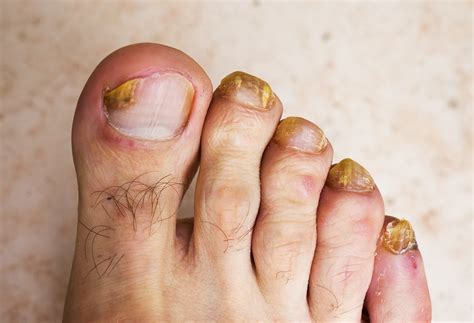 Foot Fungus Remedies Foot Care Tips