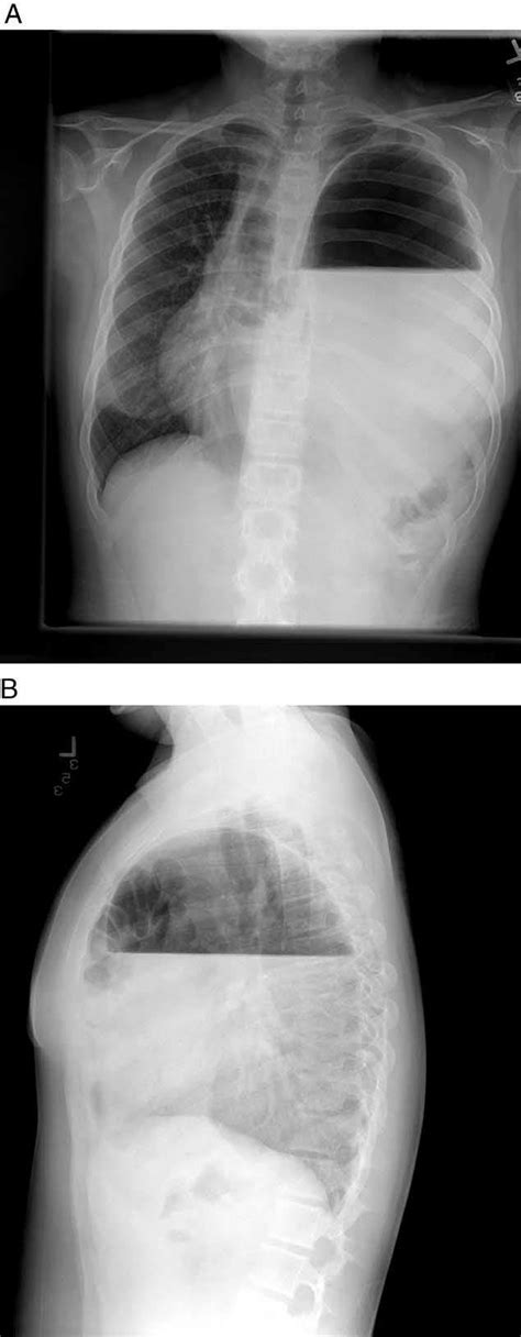 Posteroanterior A And Lateral B Views Of Preoperative Chest