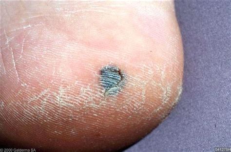 Ecchymosis is defined as hematomas large. 💊 Petechiën: oorzaken, behandelingen, fotos , en meer - 2021