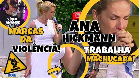 Violencia Ana Hickmann viraliza em vídeo com hematomas da agressão de Alexandre Correa na