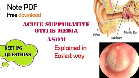 acute suppurative otitis media asom ent easy explanation stages diagnosis management