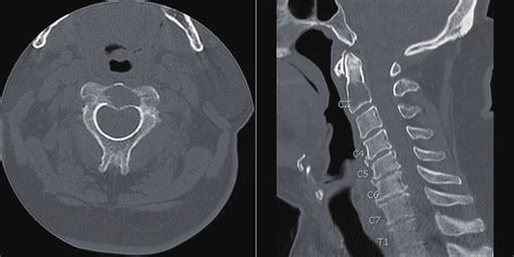 Pre Operative CT Scan Of The Cervical Spine Showing C Vertebral Body Download Scientific