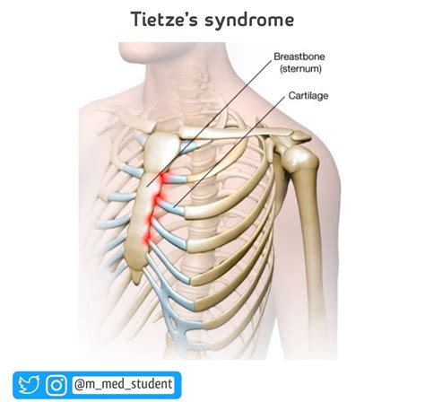 Tietzes Syndrome Costochondritis