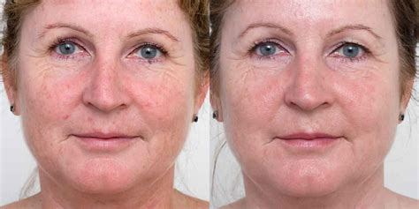 Ipl For Pigmentation And Facial Veins Thegoodskinplace