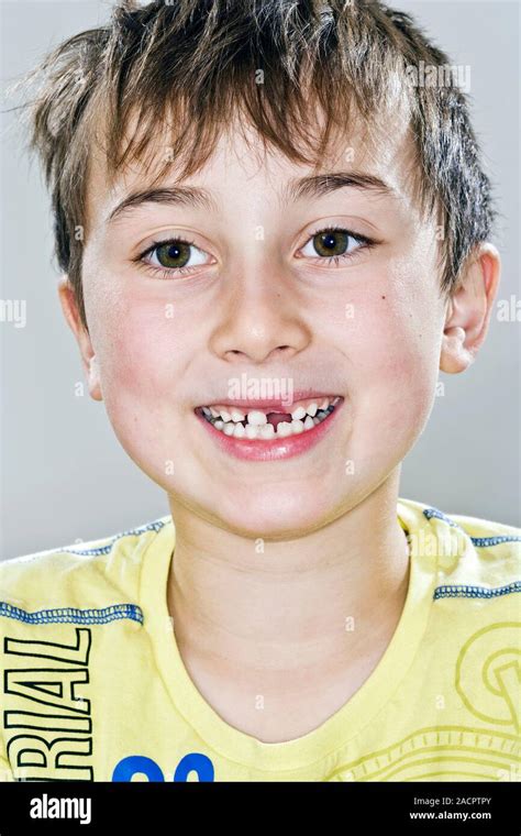 Loss Of Milk Teeth 7 Year Old Boy Missing Some Of His Primary Milk