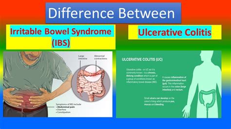 Difference Between Irritable Bowel Syndrome Ibs And Ulcerative Colitis Youtube