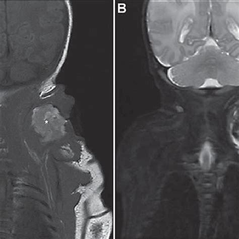 Left Posterior Neck Mass With An Ulcer Like Opening In The Center