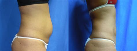Liposuction Abdomen Flanks Before And After Pictures Case Coeur