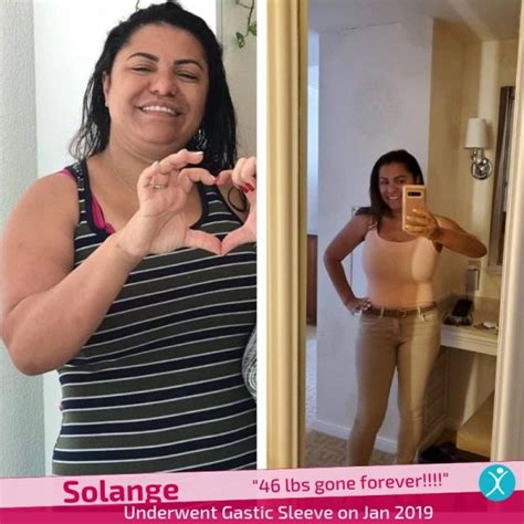 Gastric Sleeve Surgery Success Stories With Before After Photos