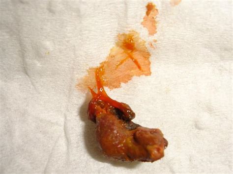 Colonoscopy is usually the first port of call for bowel cancer. GliderGossip - wet stool