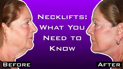 Can I Get A Neck Lift Without A Facelift Youtube