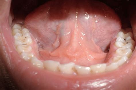 Sublingual Swelling Developed During The End Of Initial Phase Of