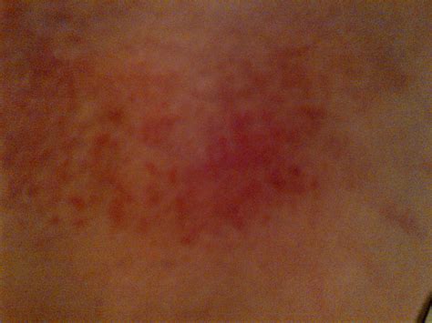 Red Rash On Back Pictures Photos